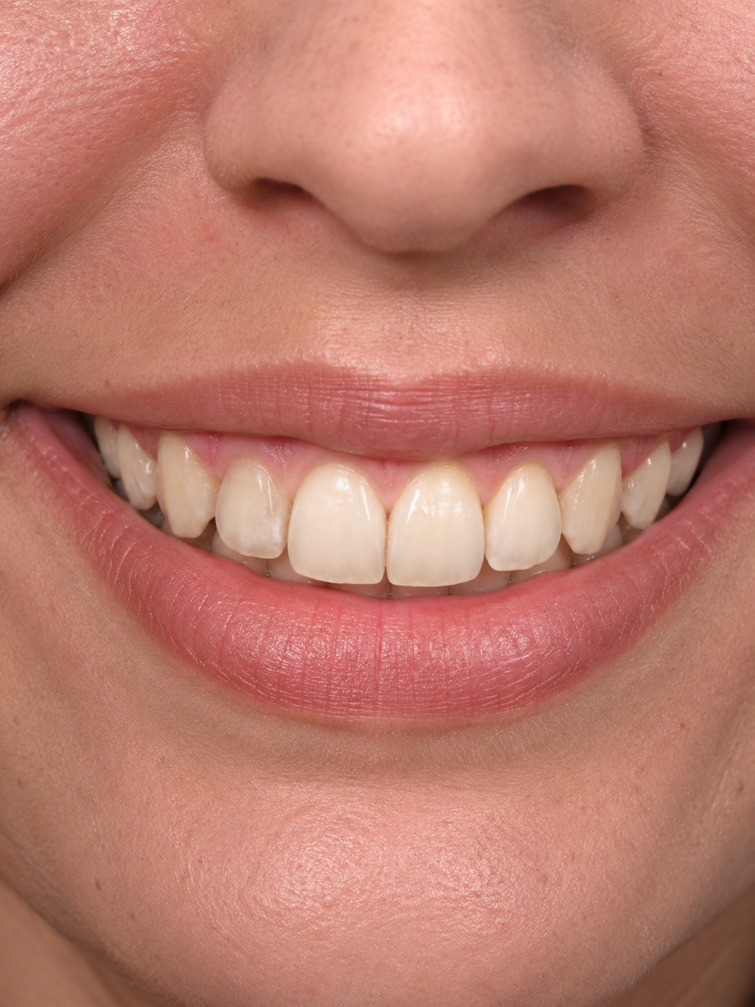 Case — aligners