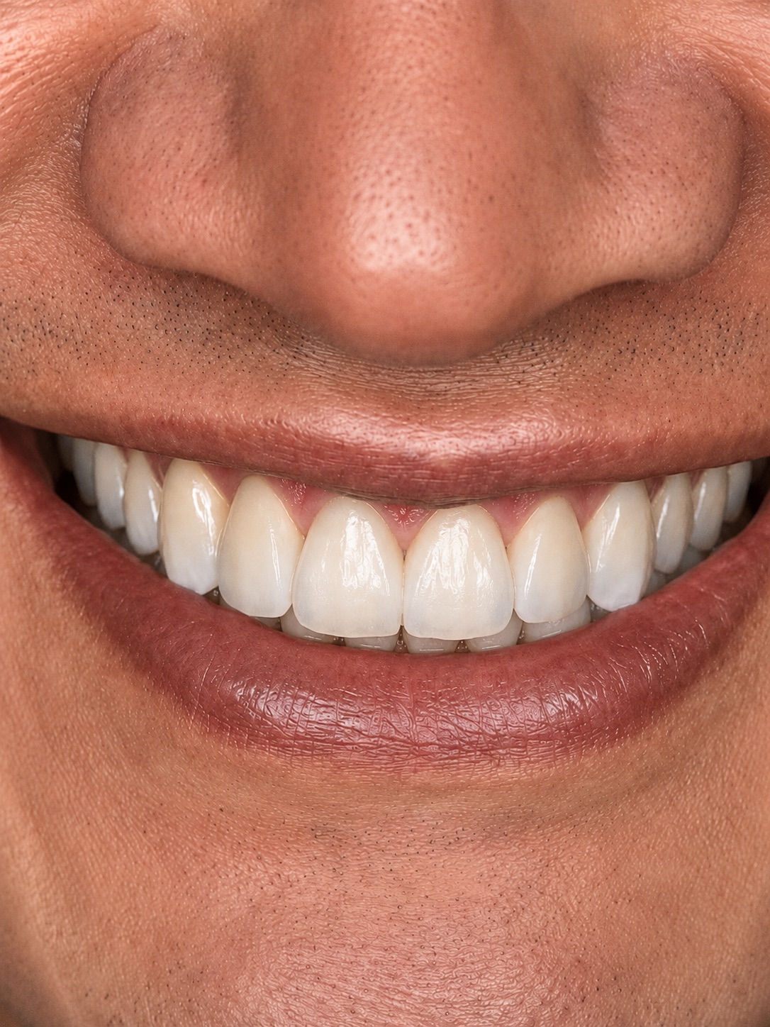 Case — dental implant