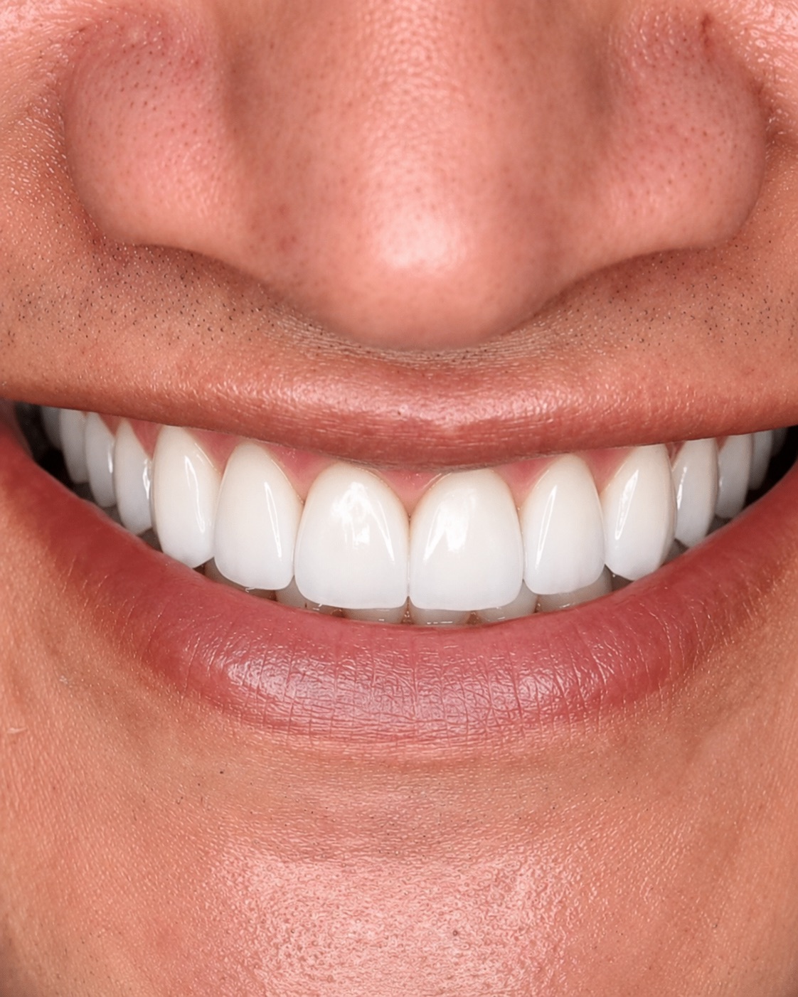 Case — dental veneers