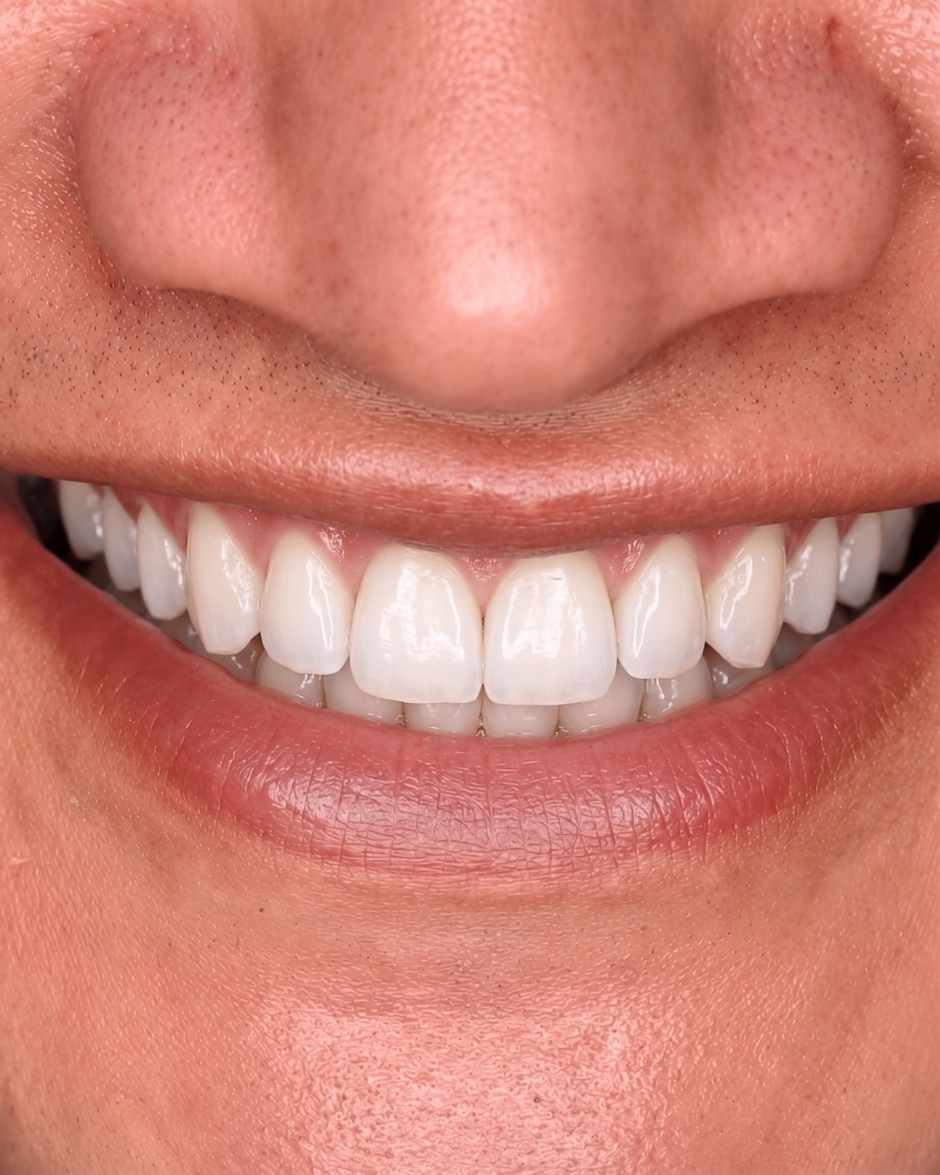 Case — teeth whitening